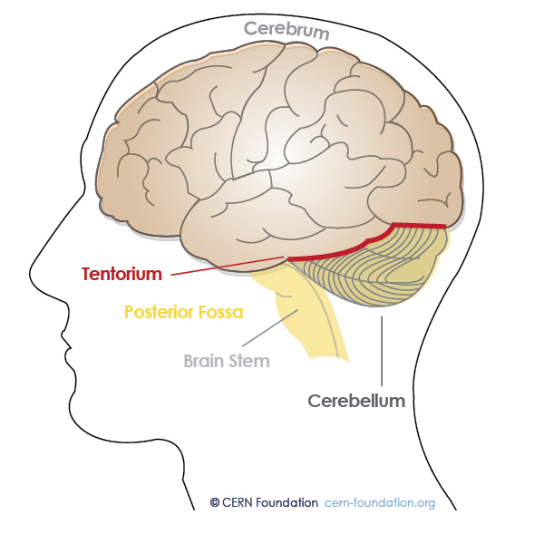 Spine and Brain Tumor and Anatomy | CERN Foundation