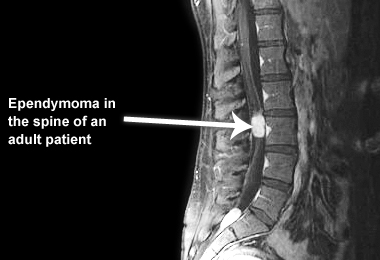 Эпендимома спинного